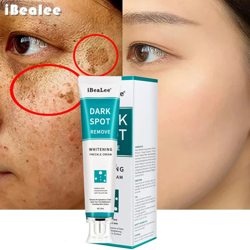 Whitening Freckle Cream Remove - đánh giá và giá Skincare Glowing