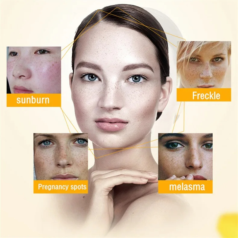 Whitening Freckle Cream Remove - đánh giá và giá Skincare Glowing