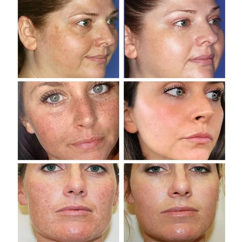 Whitening Freckle Cream Remove - đánh giá và giá Skincare Glowing